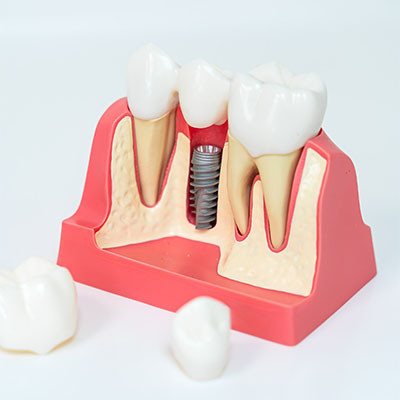 Service d’implantologie dentaire à Trazegnies | VOCLIdental