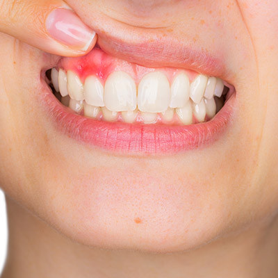 Parodontologie à Trazegnies | VOCLIdental